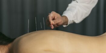 Acupuntura